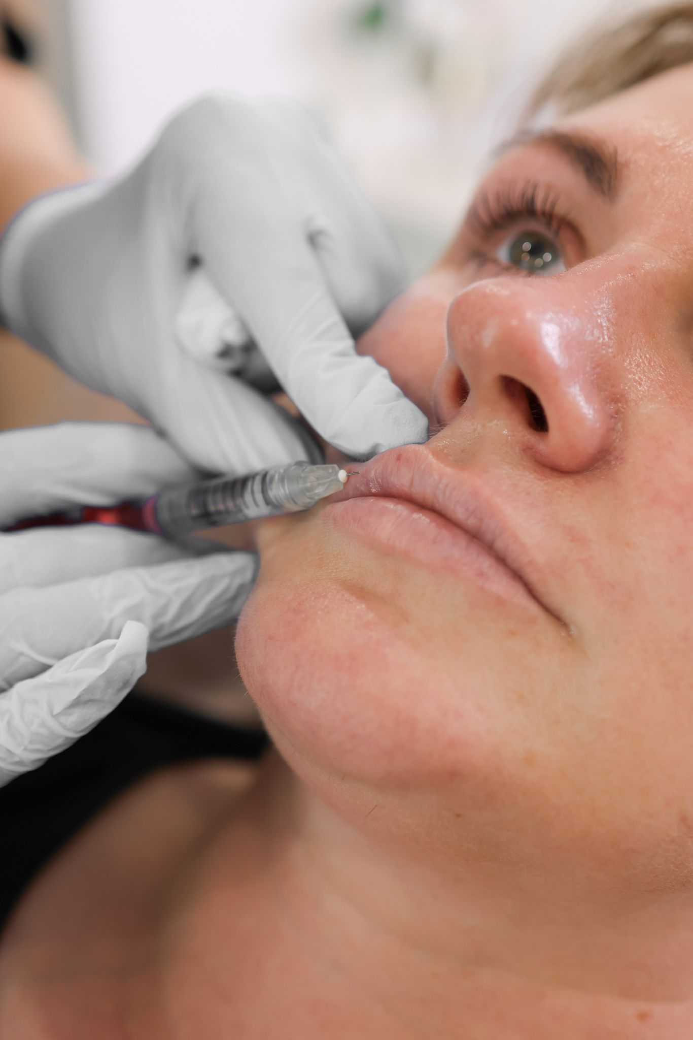 Lip Filler London: Refined Lip Enhancement with a Doctor-Led Approach