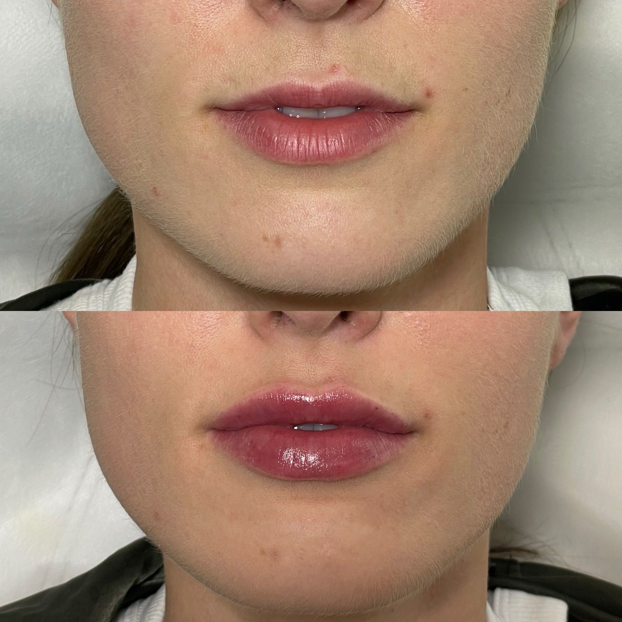 Lip Filler London: Refined Lip Enhancement with a Doctor-Led Approach