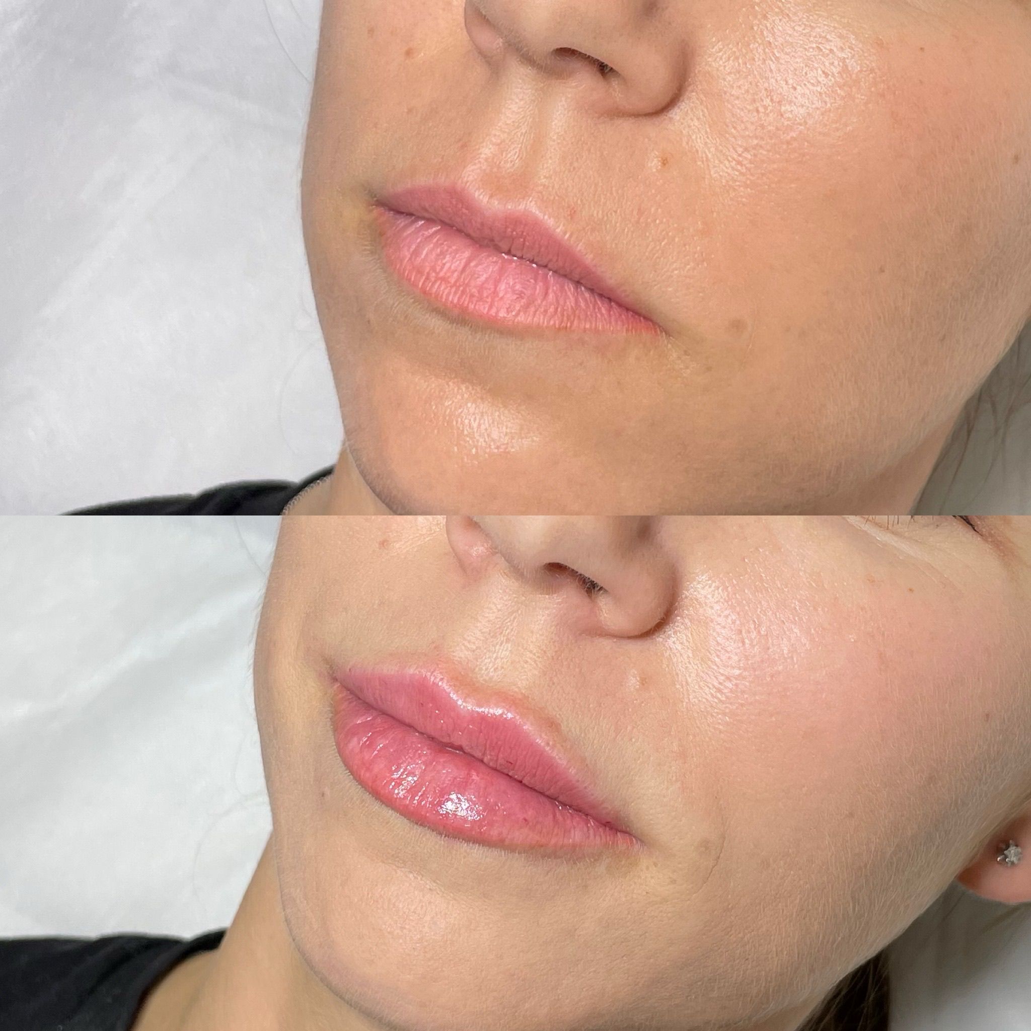 Lip Filler London: Refined Lip Enhancement with a Doctor-Led Approach